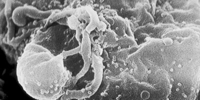 HIV/AIDS